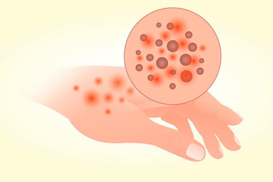Причины дерматита атопического и аллергического – бифилакт БИОТА