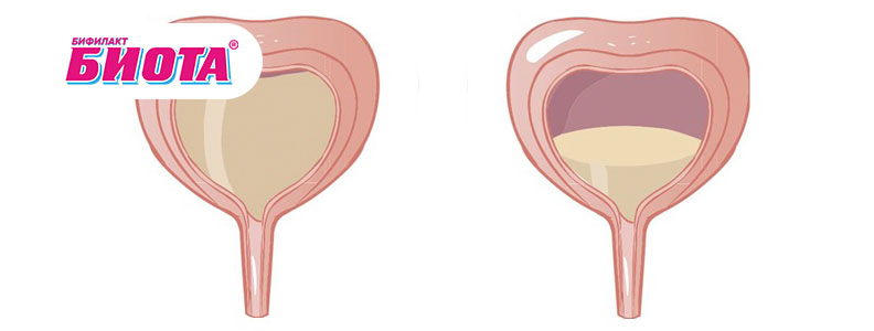 Гиперактивный мочевой пузырь у женщин, лечение, симптомы - Бифилакт БИОТА